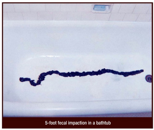 https://tongdomucvusuckhoe.net/wp-content/uploads/2012/08/5-foot-fecal-impaction-in-a-bathtub.jpg